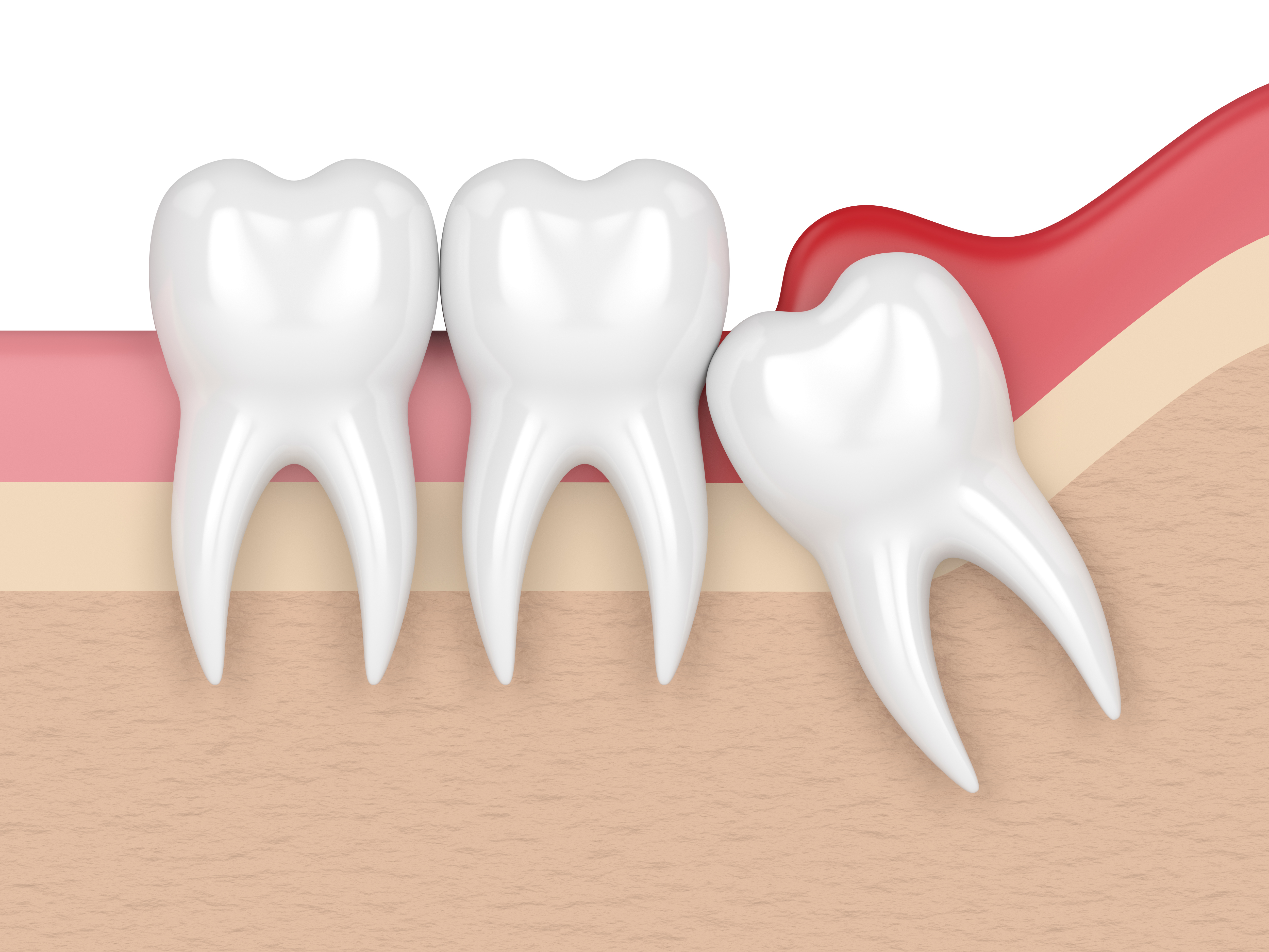 Being Wise with Wisdom teeth – KIN DENTAL CENTRE [CLEMENTI / WEST COAST]