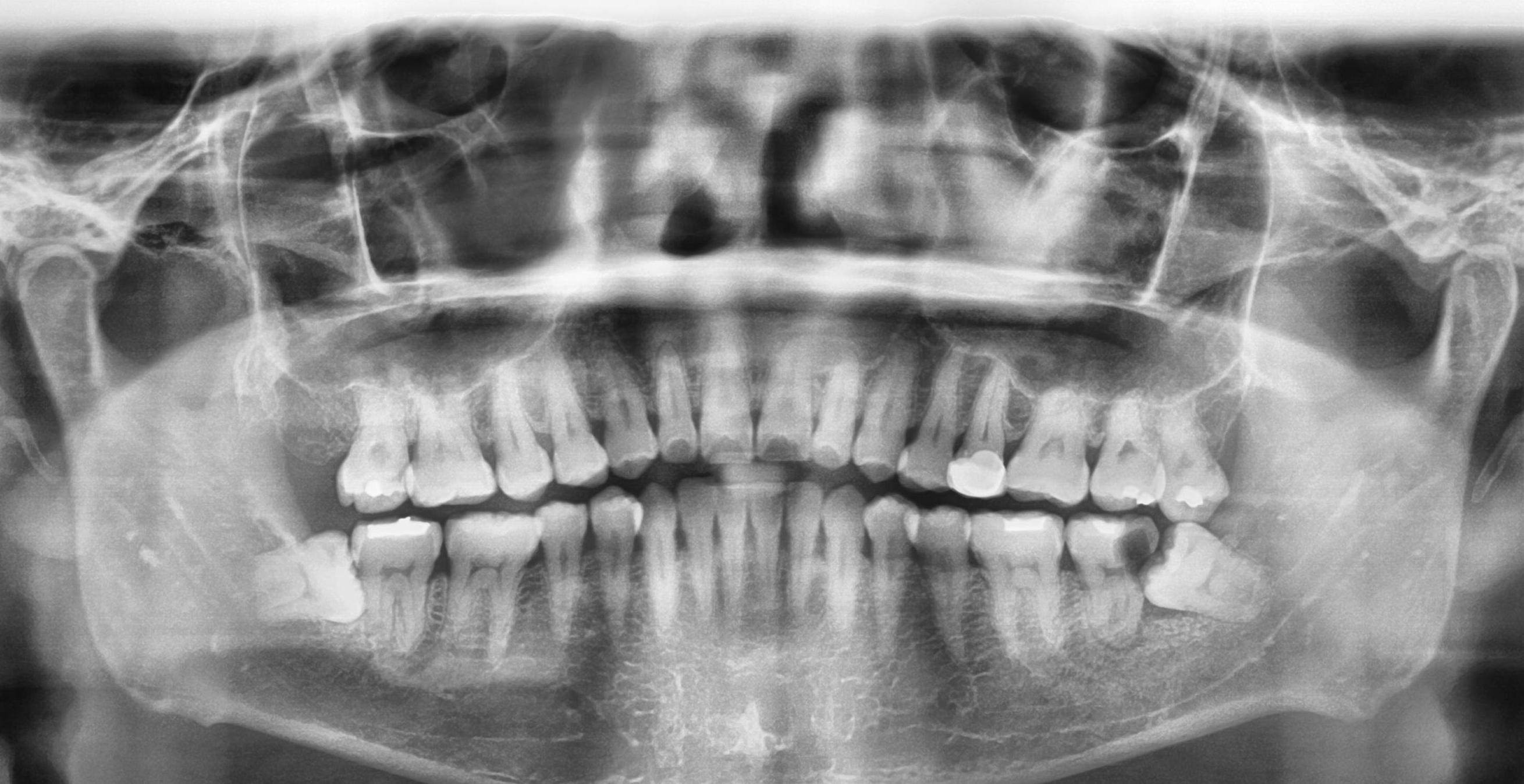 Being Wise with Wisdom teeth – KIN DENTAL CENTRE [CLEMENTI / WEST COAST]