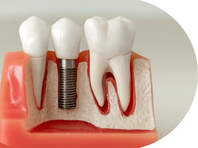 Dentist Singapore Dental Clinic Clementi West Coast Pasir Panjang Jurong East 
Bukit Batok Pandan Garden Teban Garden  Implant