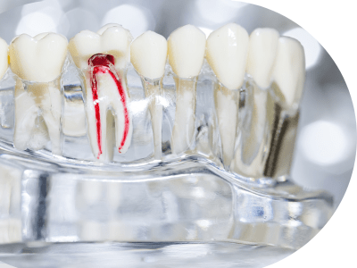 Dentist Singapore Dental Clinic Clementi West Coast Pasir Panjang Jurong East 
Bukit Batok Pandan Garden Teban Garden  Root Canal Treatment